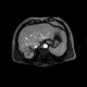 Liver metastasis of colorectal cancer, RFA: MRI - Magnetic Resonance Imaging